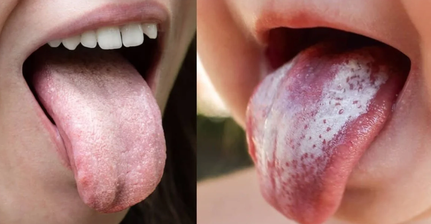geographic tongue 2
